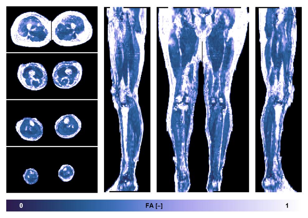 IVIM corrected whole leg muscle fractional anisotropy obtained from diffusion tensor imaging.